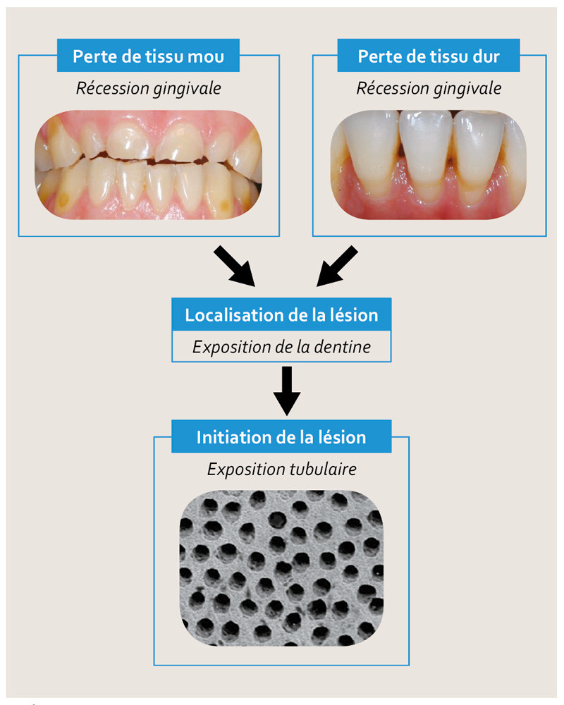 Hypersensibilité dentinaire L Information Dentaire