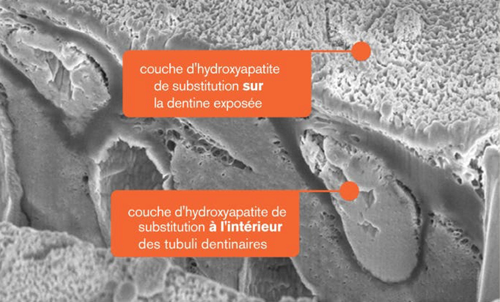 Hypersensibilité Dentinaire du Diagnostic à la Prise en charge des