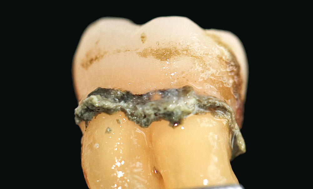 Le Tartre Et Linstrumentation Sous Gingivale L Information Dentaire