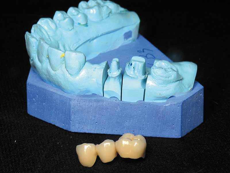 Les modèles de travail en prothèse fixée : dispositifs et conception –  L'Information Dentaire