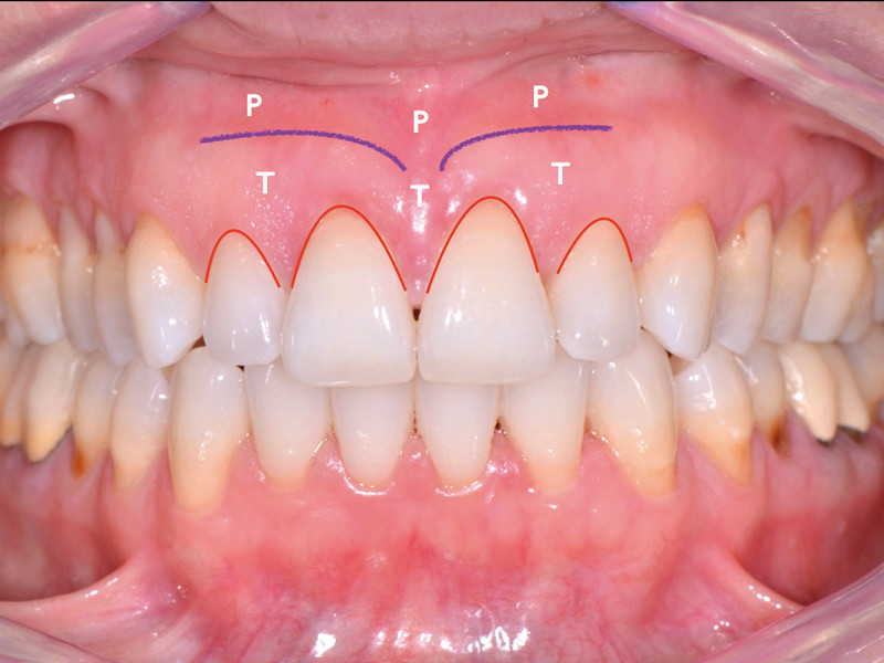 classification des récessions gingivales