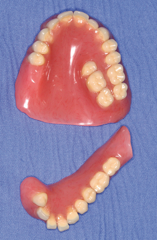Prothèses instables: colle dentaire et autres solutions