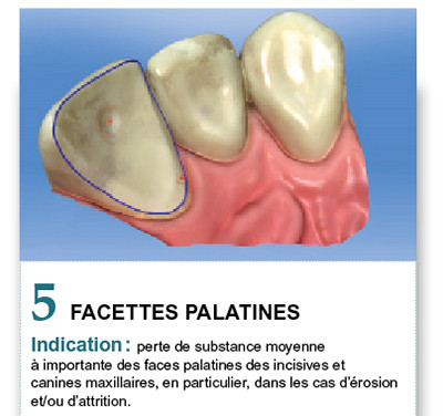 Fiches T et tableau des commandes – L'Information Dentaire