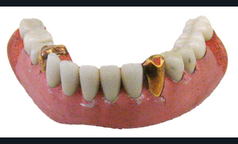 Plaques De Base Dentaires Shellac. Prothèses Dentaires Et