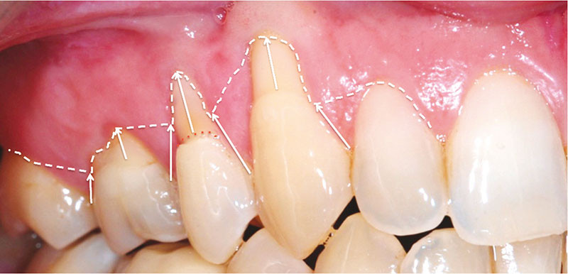 classification des récessions gingivales