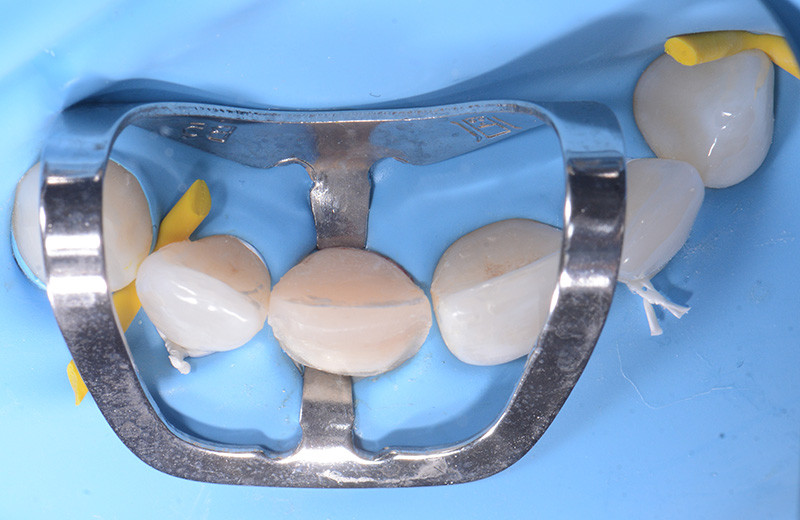 Les digues en caoutchouc en isolement dentaire : Caractéristiques et  utilisations ! - Distributeur de máteriel dentaire - Dentaltix