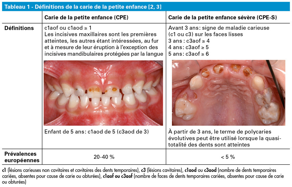 Rehabilitations Prothetiques Posterieures Et Carie De La Petite Enfance L Information Dentaire