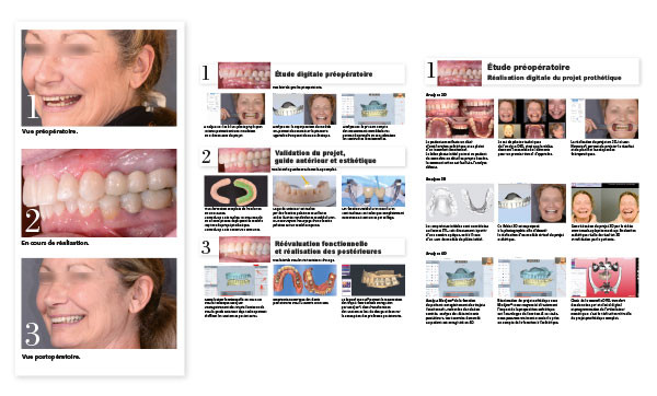 L'impression 3d dentaire au service de la dentististerie - CFAO