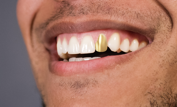 Peut-on accepter de couronner une dent saine ? – L'Information Dentaire