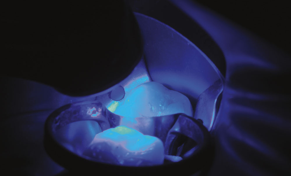 Lampe Dentiste Photopolymère Avec Lampe Bleue Lumineuse