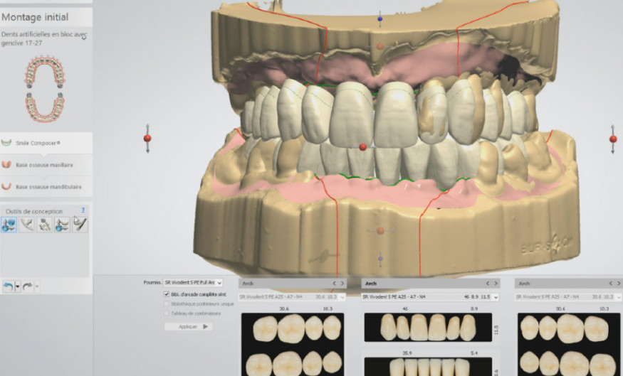 Prothèse amovible - Centre Dentaire Philippe Rousseau