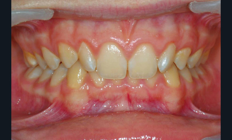 Traitement Dune Malocclusion De Classe Ii 2 – Linformation Dentaire