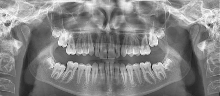 Fig. 8 - Radiographie panoramique de début de traitement.