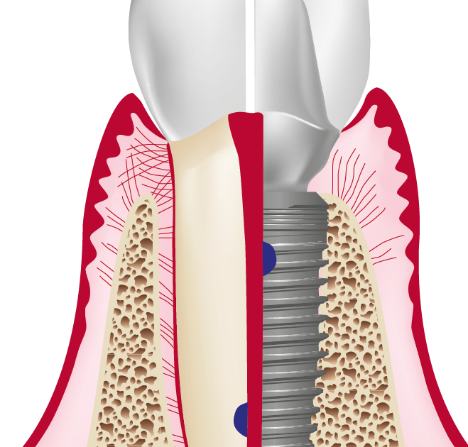 Le réglage de l'occlusion sur implants - Implantologie