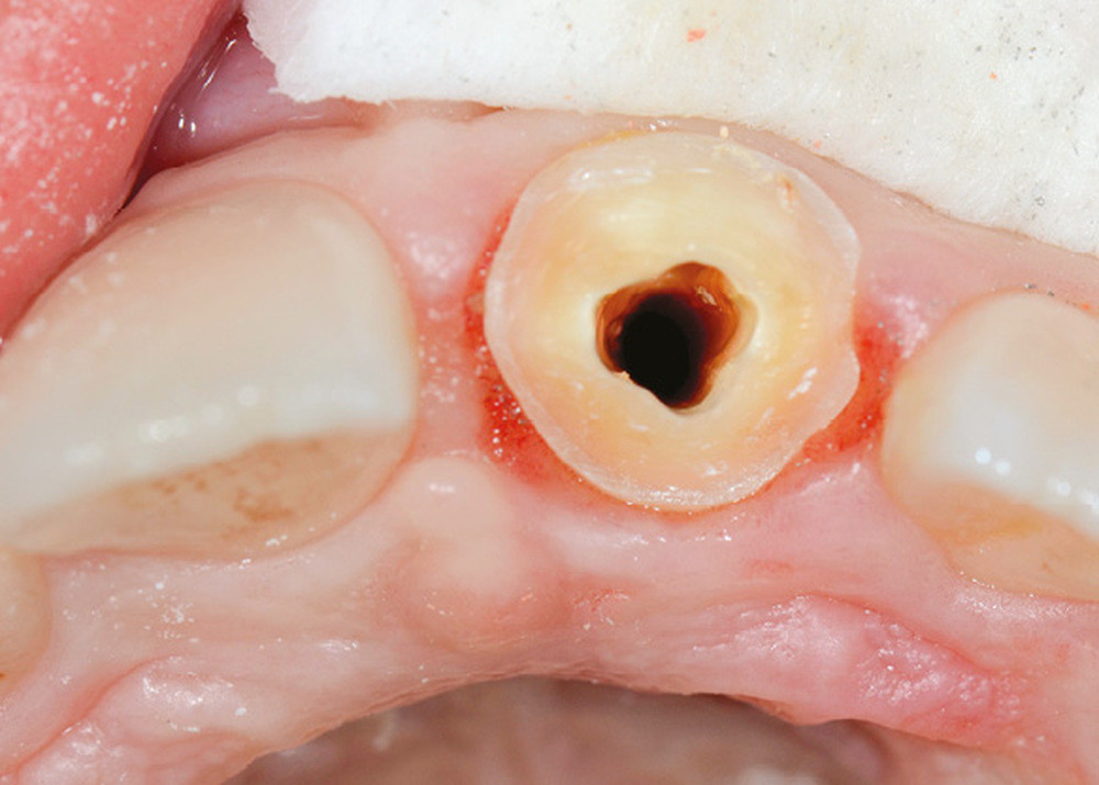 couronnes temporaires,100PCS dent provisoire, couronne molaire antérieure,  couronne résistante de dents de différentes tailles, dent temporaire, dents