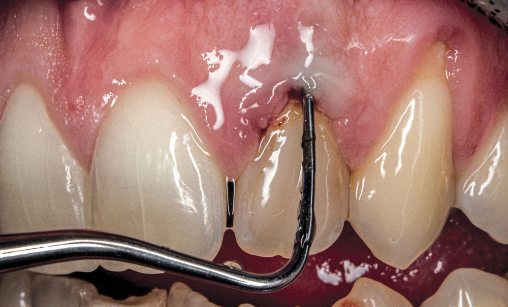 Extraction implantation et provisoire immédiates