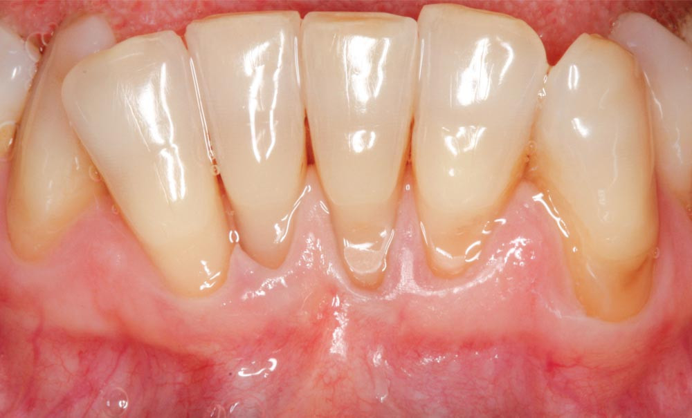 classification des récessions gingivales