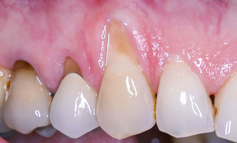 classification des récessions gingivales