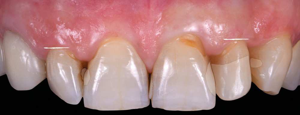 Les facettes dentaires, une thérapeutique minimalement invasive –  L'Information Dentaire