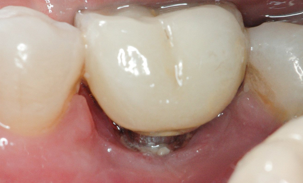 Traitement d'une péri-implantite et son suivi : est-ce réellement aussi  simple ? – L'Information Dentaire